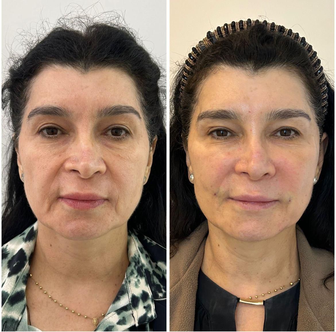 Antes e depois — Harmonização facial